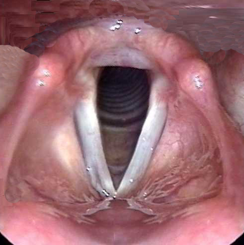 Photo des cordes vocales ouvertes